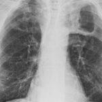Tuberculosis