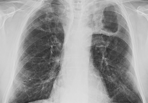 Tuberculosis